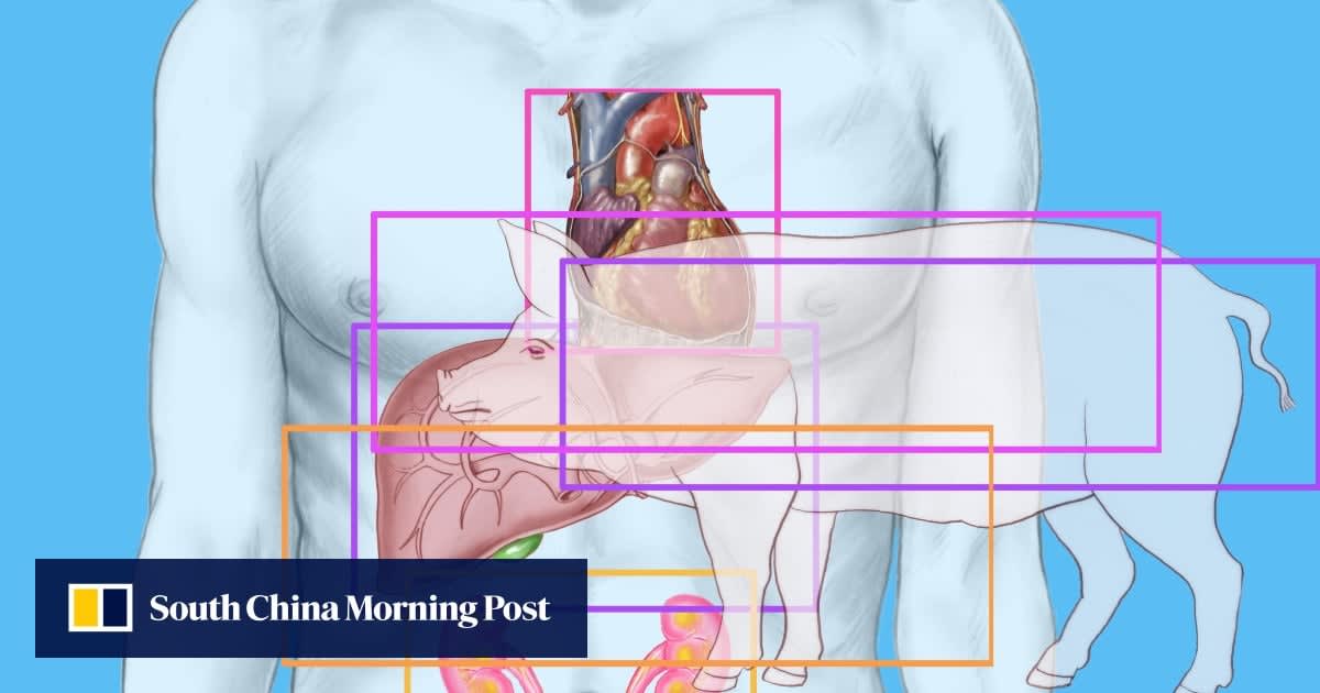Medical team performing groundbreaking pig-to-human organ transplant surgery in modern operating room