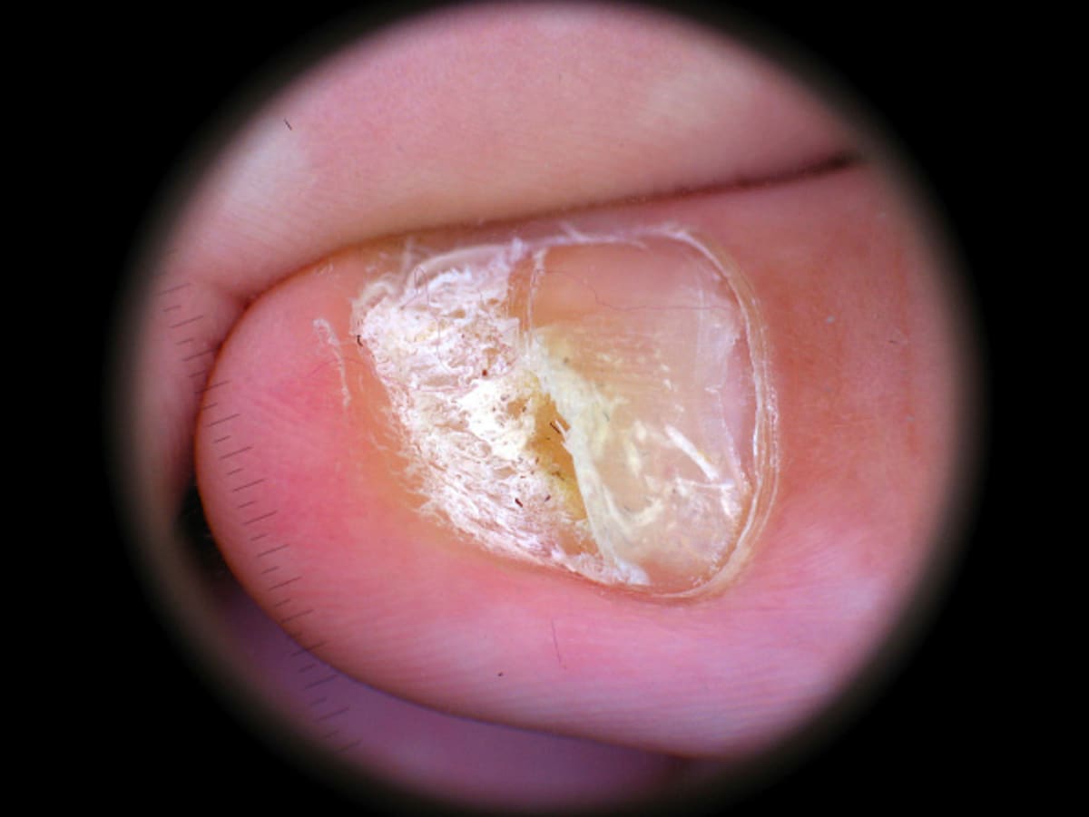 Keratin Discovery Opens Door to New Skin Disease Treatments - Image 3