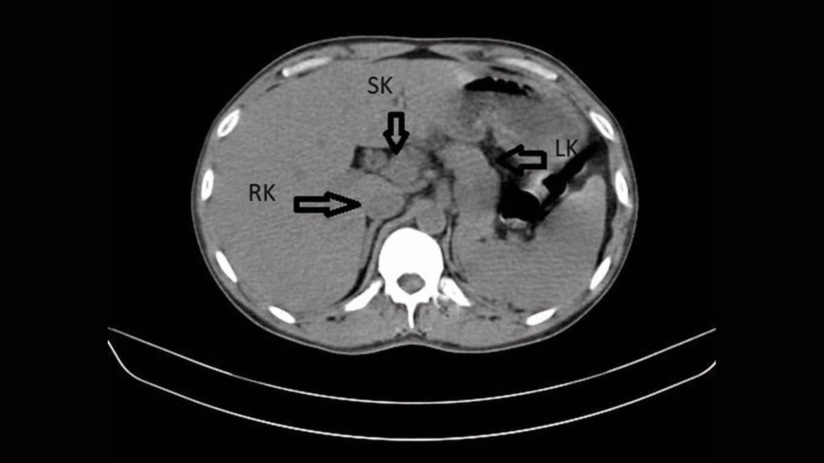 Man Treated for UTI Discovers He Has Three Kidneys