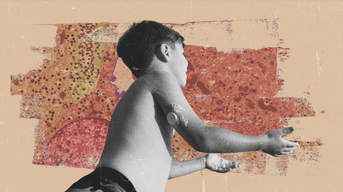 Type 1 Diabetes Cure Moves Closer With New Cell Therapy - Image 2