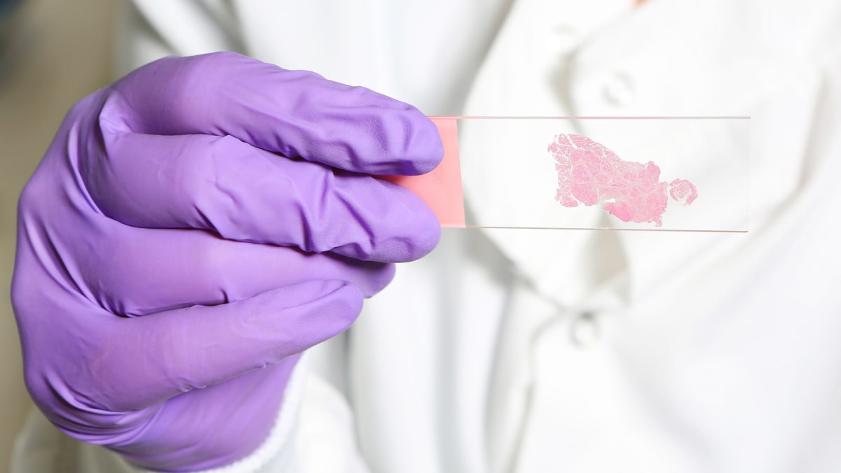 AI Learns to Spot Cancer by Mimicking Human Pathologists - Image 2