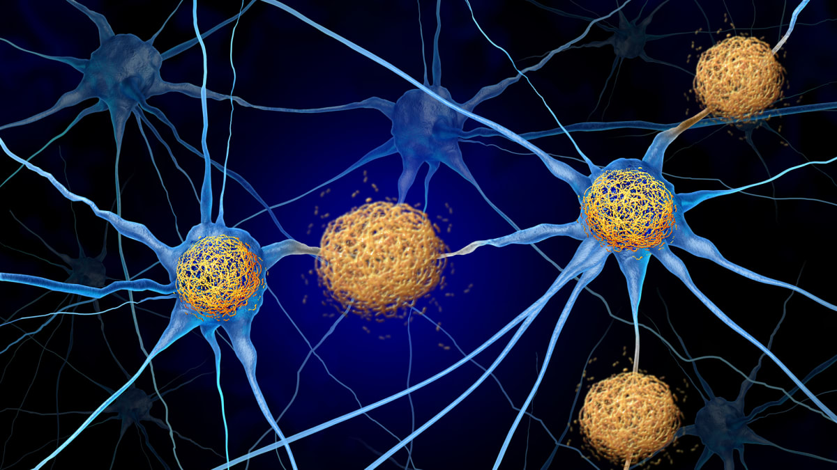 New Blood Tests Catch Alzheimer's Earlier Than Ever - Image 4