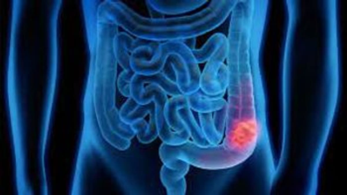 Prostate Cancer Patients Get Same Results in Fewer Visits - Image 5