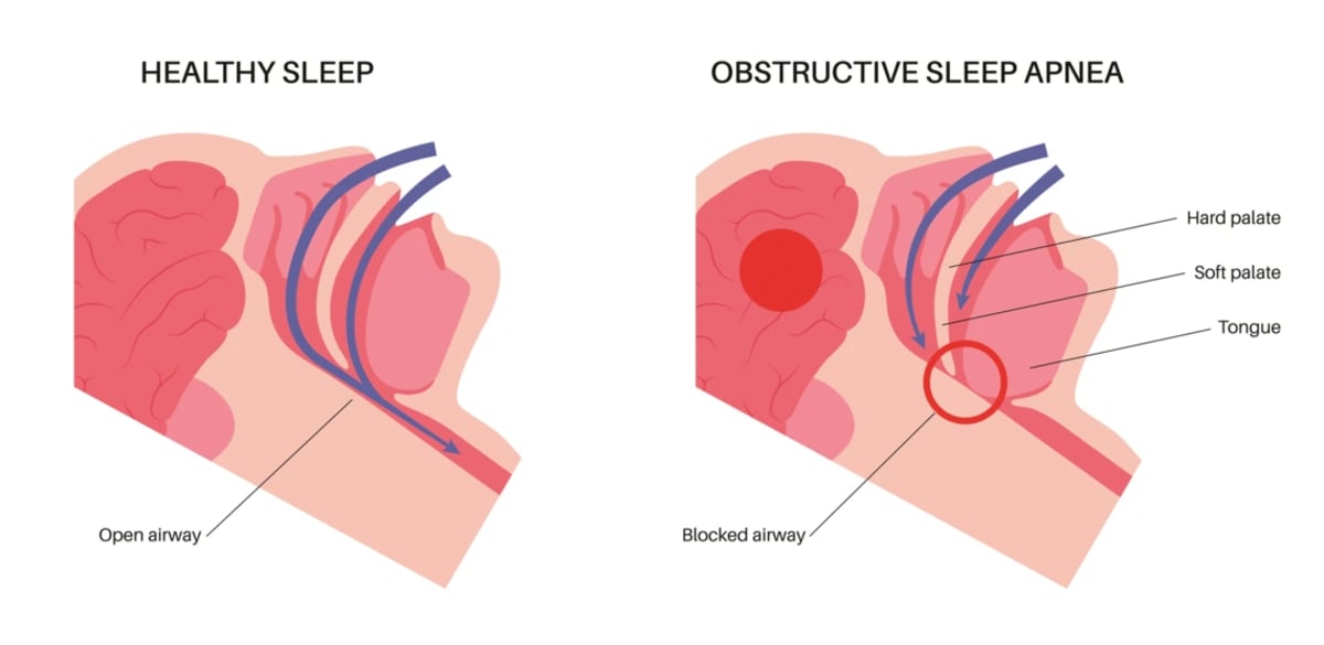 $14M Study Compares 3 Sleep Apnea Treatments for 47M Americans - Image 3