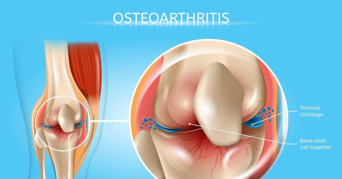 AI and genetics identify WNK2 inhibitor for osteoarthritis treatment