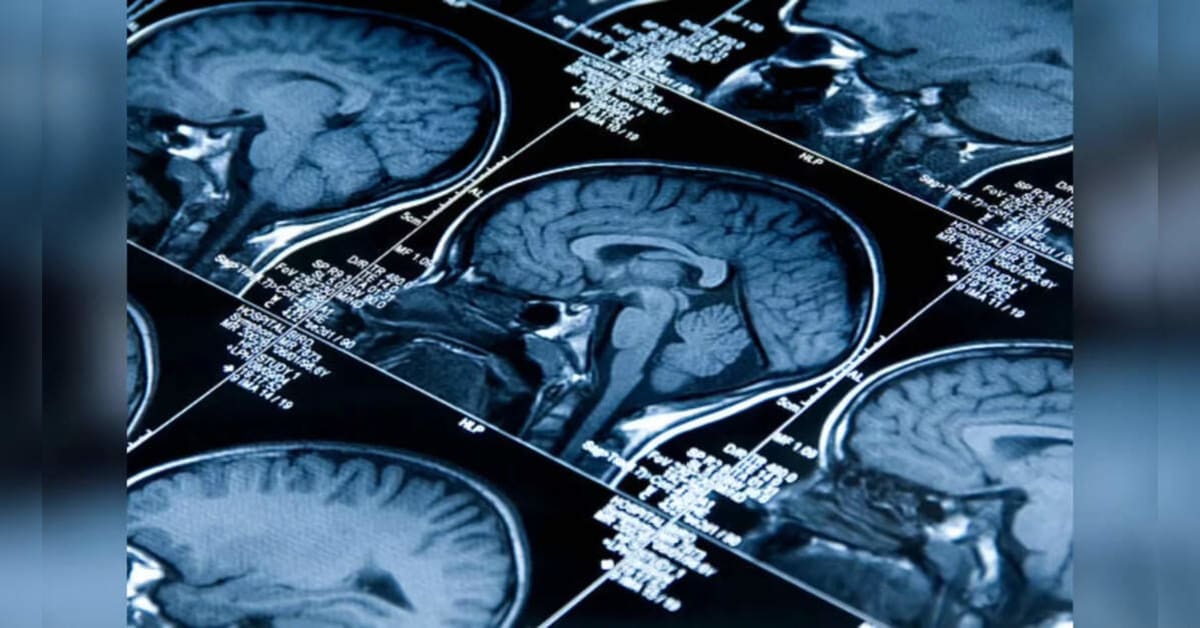 Colorful AI-generated brain scan showing different regions aging at varying rates in medical research setting