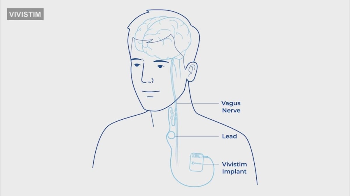 Nebraska Stroke Patients Getting Brain-Boosting Implant - Image 2
