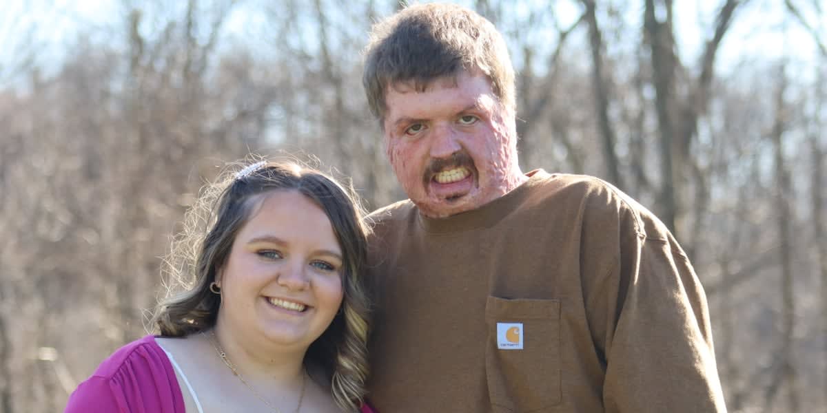Burn Survivor Inspires Thousands After Learning to Walk Again