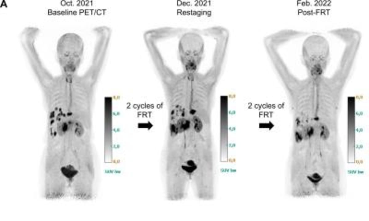 Medical scan showing tumor response in pancreatic cancer patient receiving FAP-targeted radiopharmaceutical therapy