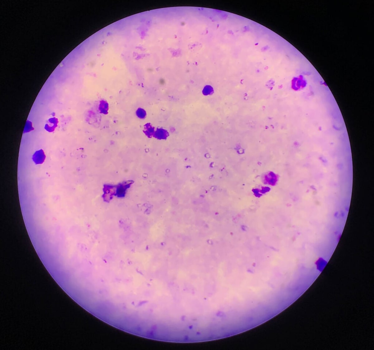 Plasmodium falciparum malaria parasites viewed under microscope in laboratory research setting