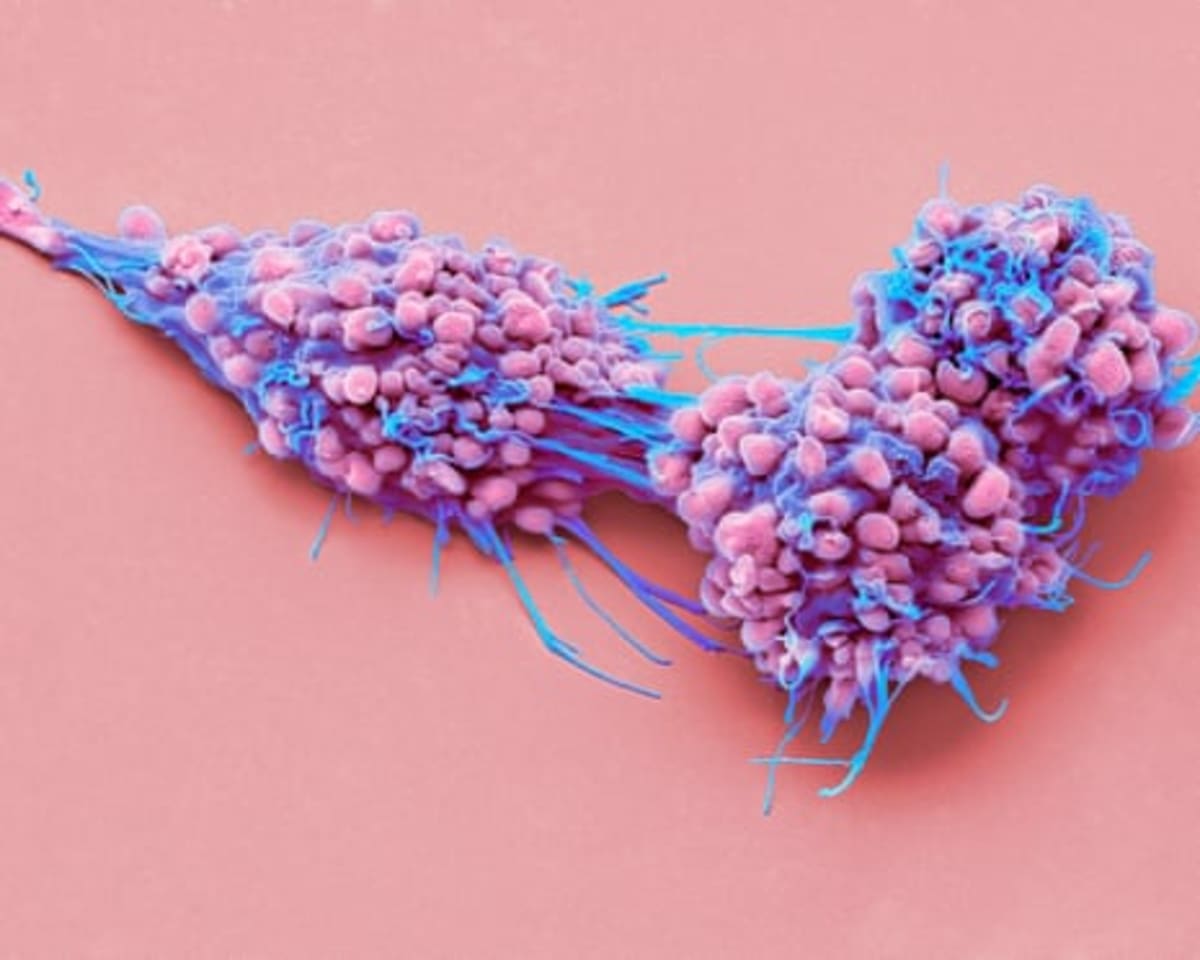England Approves First New Ovarian Cancer Drug in 20 Years - Image 3