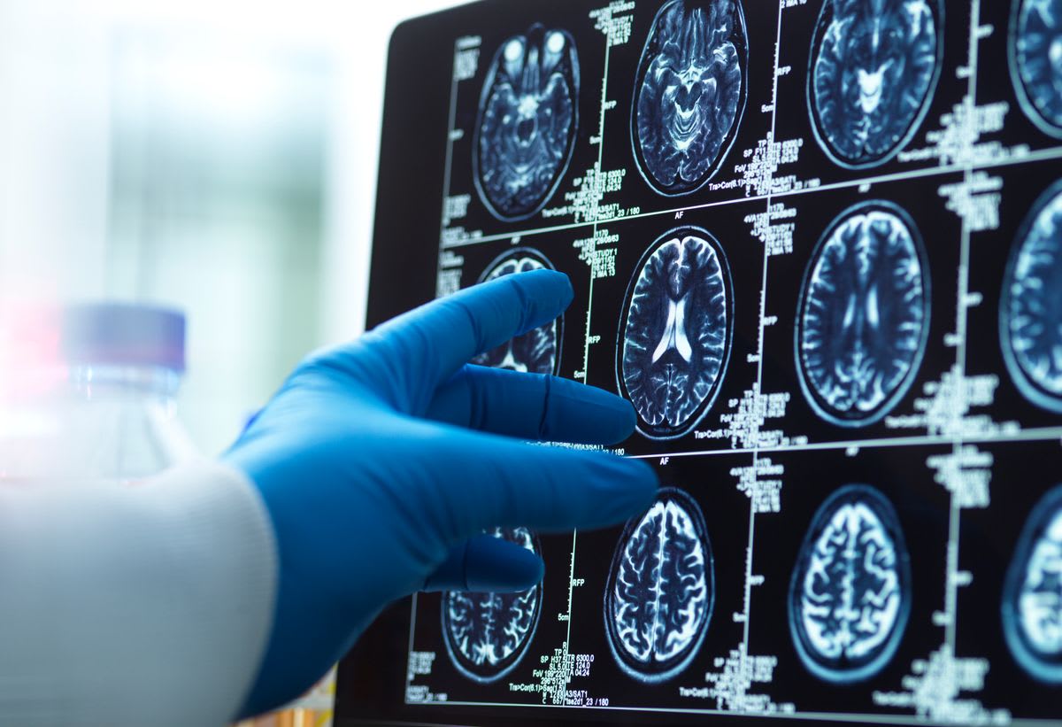 High-Dose Flu Shot Cuts Alzheimer's Risk 55% in Study - Image 5