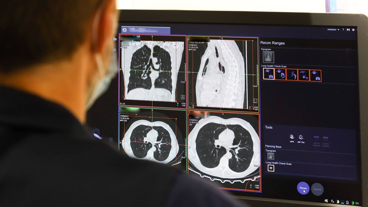 AI Detects Pancreatic Cancer 16 Months Before Doctors