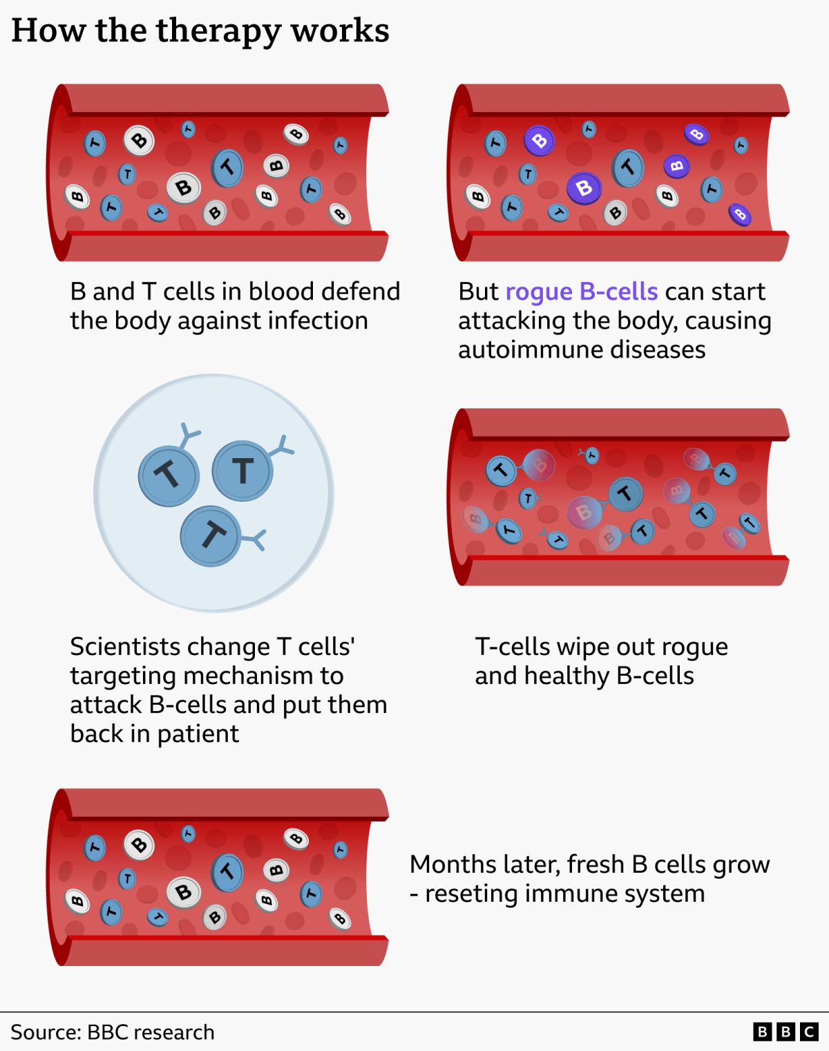 Experimental Immune Reset Puts Lupus Into Remission - Image 4