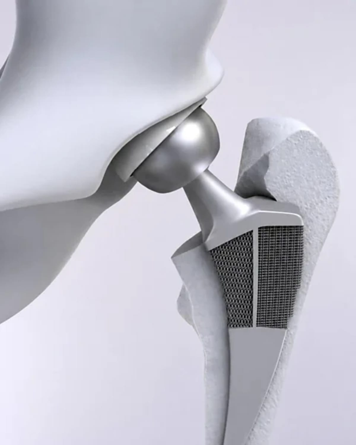 AI Designs Hip Implants That Last Longer Than Ever - Image 3