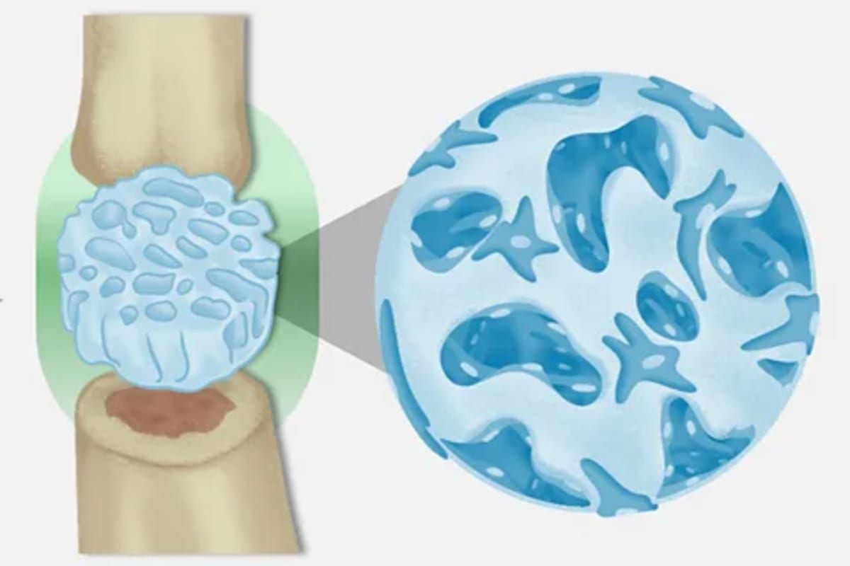 AI Designs Hip Implants That Last Longer Than Ever - Image 4
