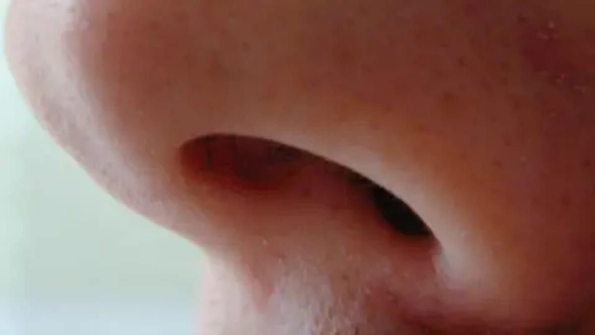 New Nose Treatment Transforms Lives in Hull Hospitals - Image 2