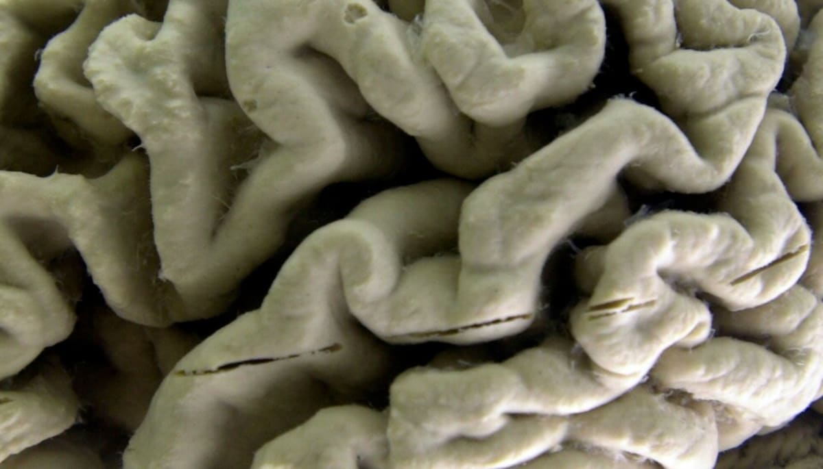 Korean Researchers Find Protein That May Reverse Alzheimer's - Image 4