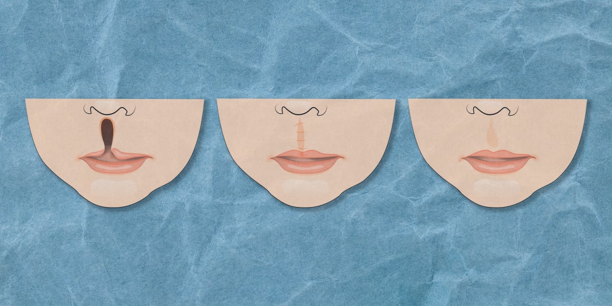 Young woman smiling confidently after multiple reconstructive surgeries for cleft lip and palate