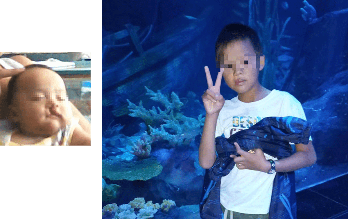 Beijing Hospital Performs 11,000 Free Cleft Surgeries - Image 4