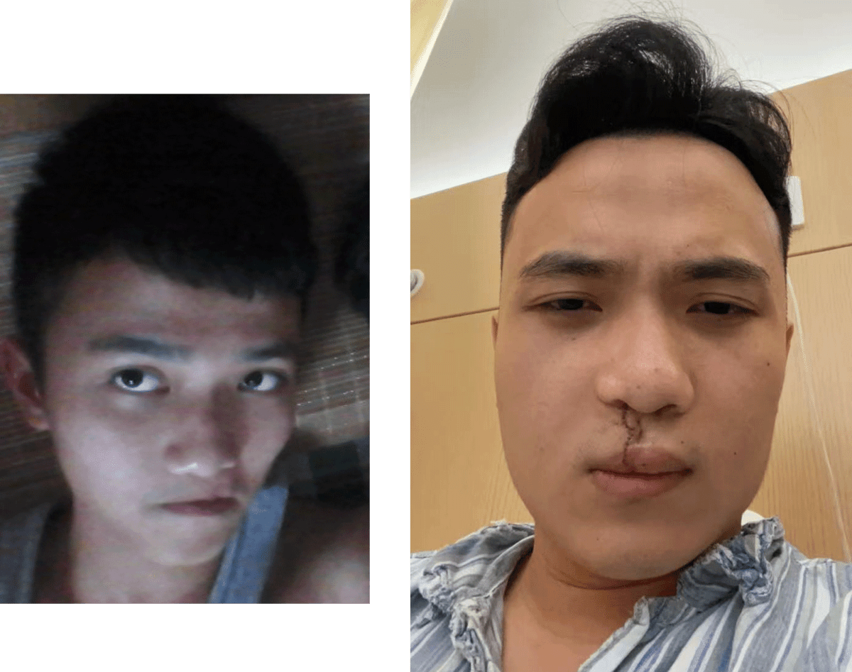 Beijing Hospital Performs 11,000 Free Cleft Surgeries - Image 5