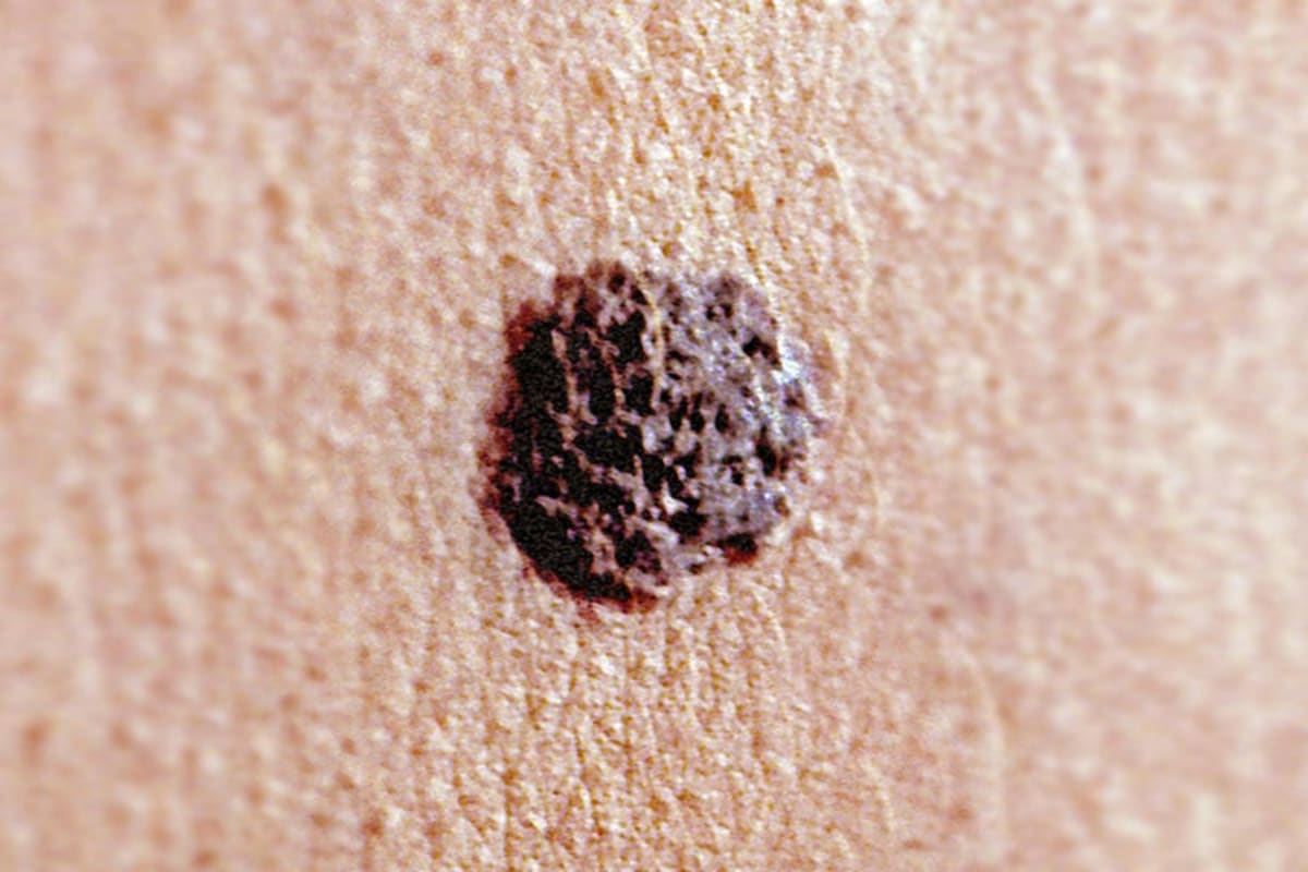 mRNA Cancer Vaccine Keeps 70% Melanoma-Free After 5 Years - Image 2