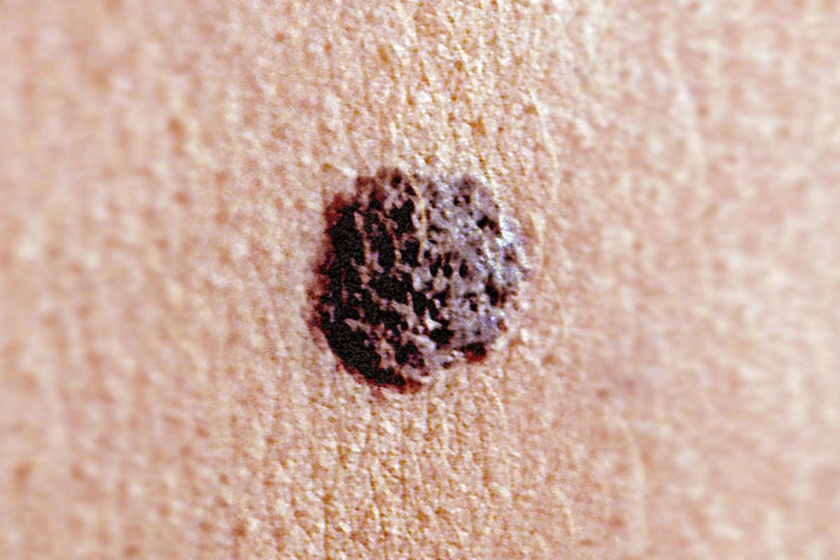 Scientist examining melanoma cells under microscope in cancer research laboratory