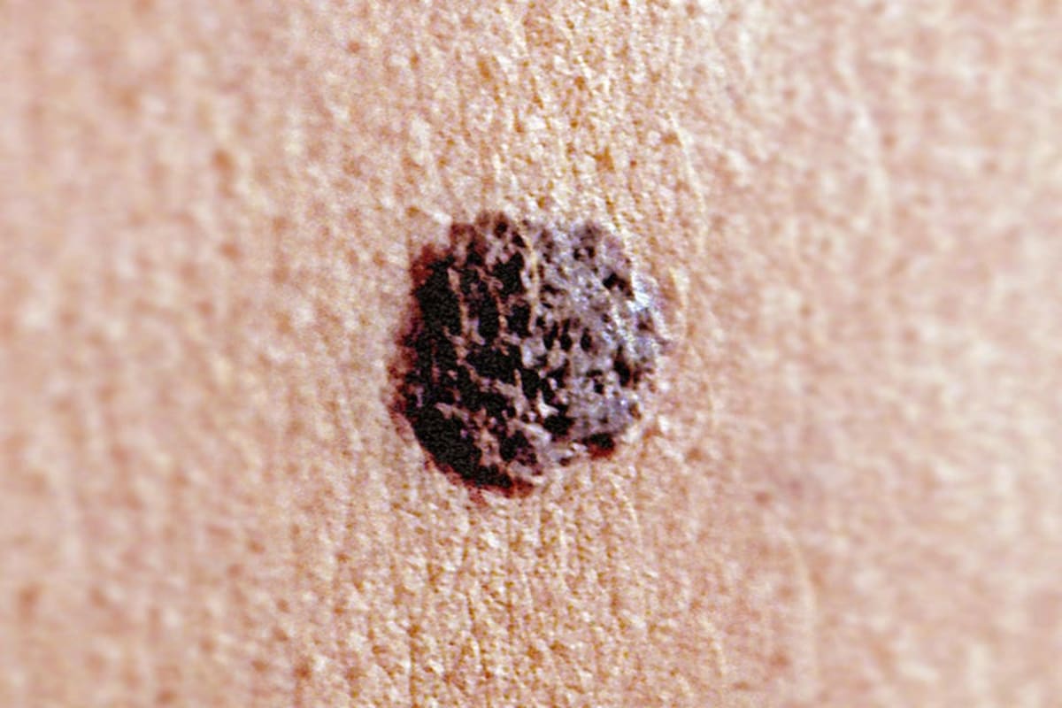 mRNA Cancer Vaccine Keeps 70% Melanoma-Free After 5 Years - Image 3