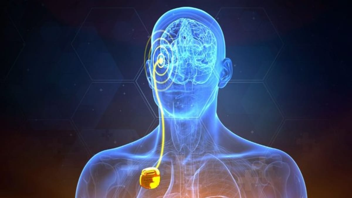 Australia Gets Adaptive Brain Implant for Parkinson's - Image 4