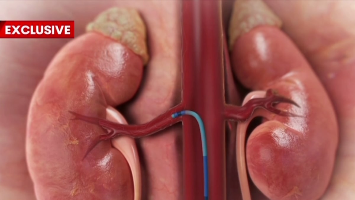 Perth Hospital Cuts Blood Pressure 20% With New Procedure - Image 4