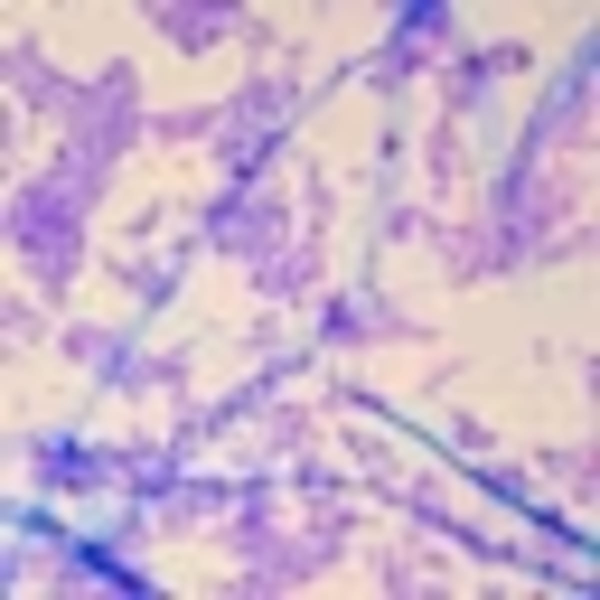 Doctors Create Survival Roadmap for CAR-T Cancer Patients - Image 3