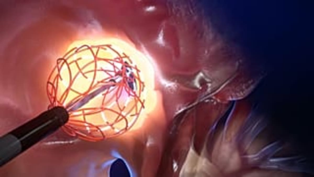 EU Catheter Breakthrough Treats Heart Arrhythmia Faster - Image 3