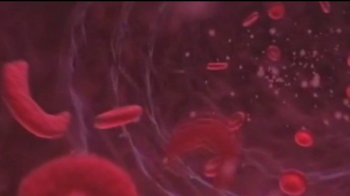 Michigan Man First to Receive Sickle Cell Gene Therapy - Image 2