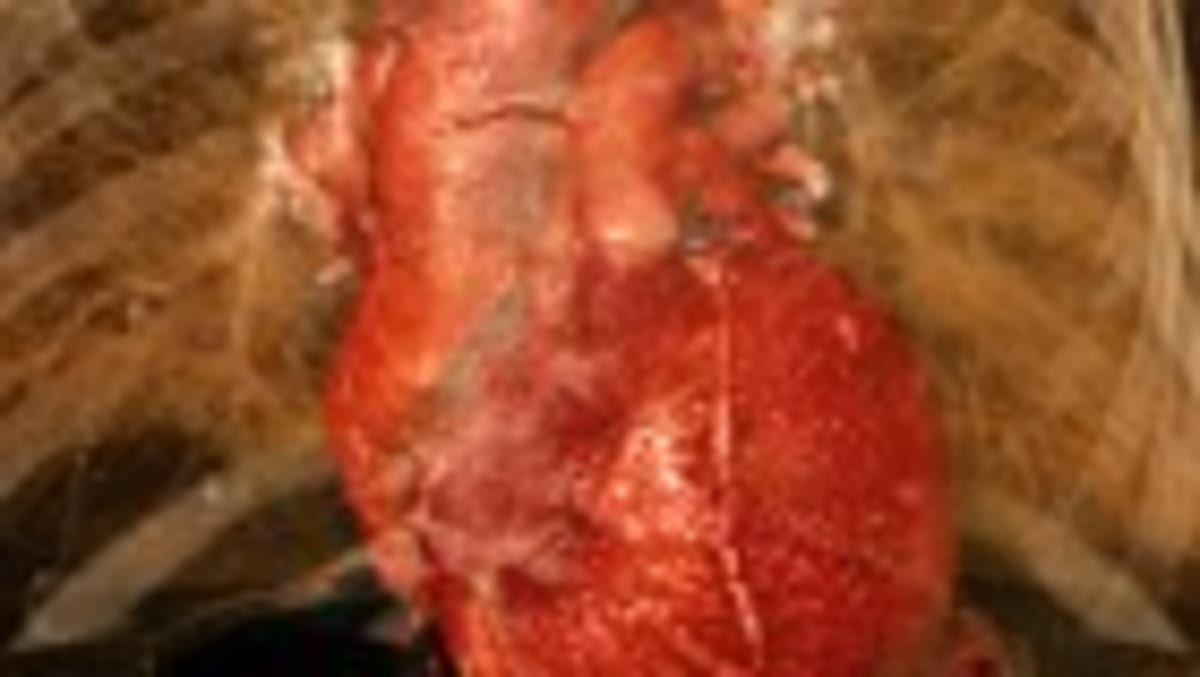 Magnetic Gel Seals Hearts, Prevents Strokes After Surgery - Image 2