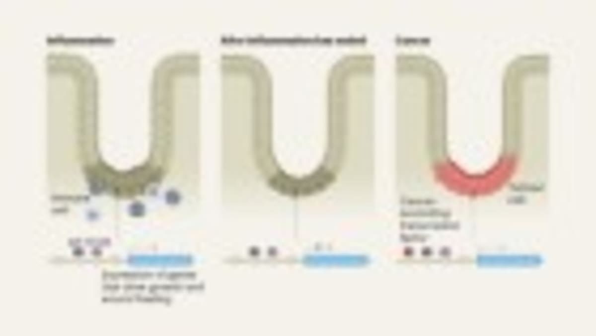 England's Lung Cancer Screening Saves Lives Early - Image 3