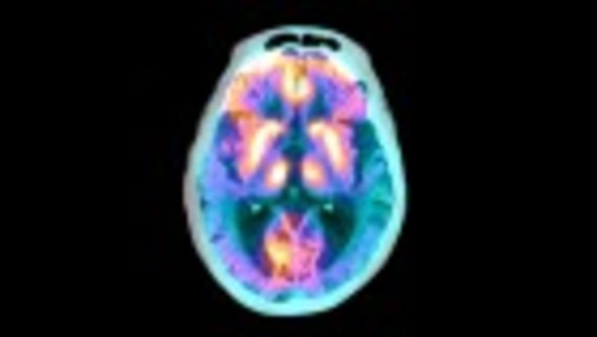 China Approves World's First Brain Chip for Paralysis - Image 4