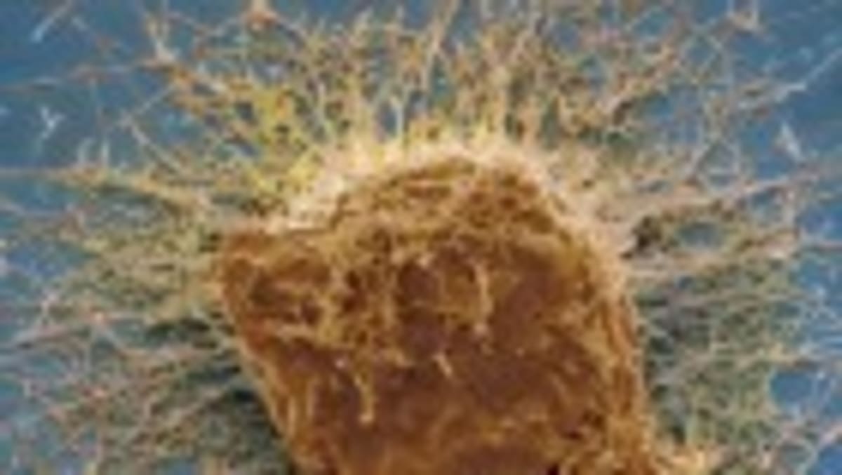 CAR-T Therapy Cures Woman With 3 Autoimmune Diseases - Image 2