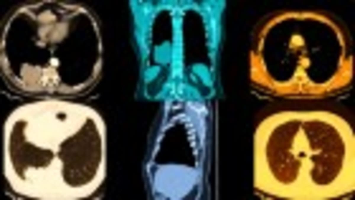 Scientists Find Brain Link May Unlock Lung Cancer Treatment - Image 2