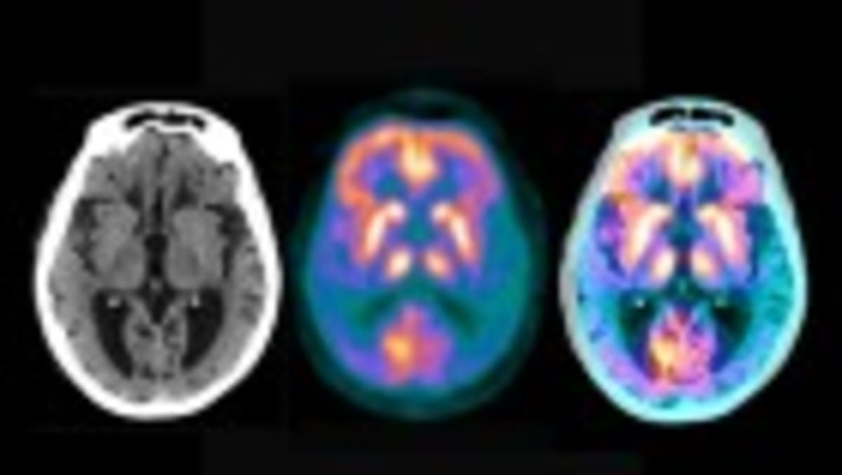 Doctor Improves After First-Ever Personalized ALS Treatment - Image 3