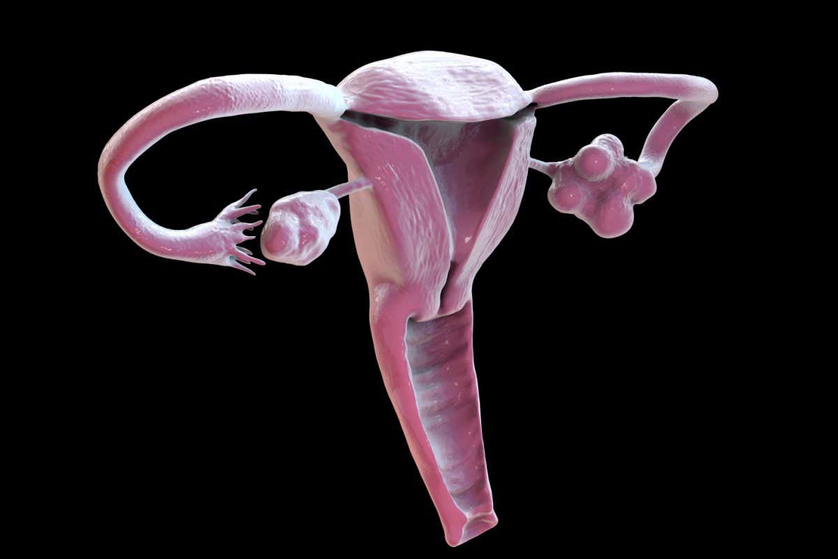 PCOS Gets New Name That Finally Explains the Condition - Image 4