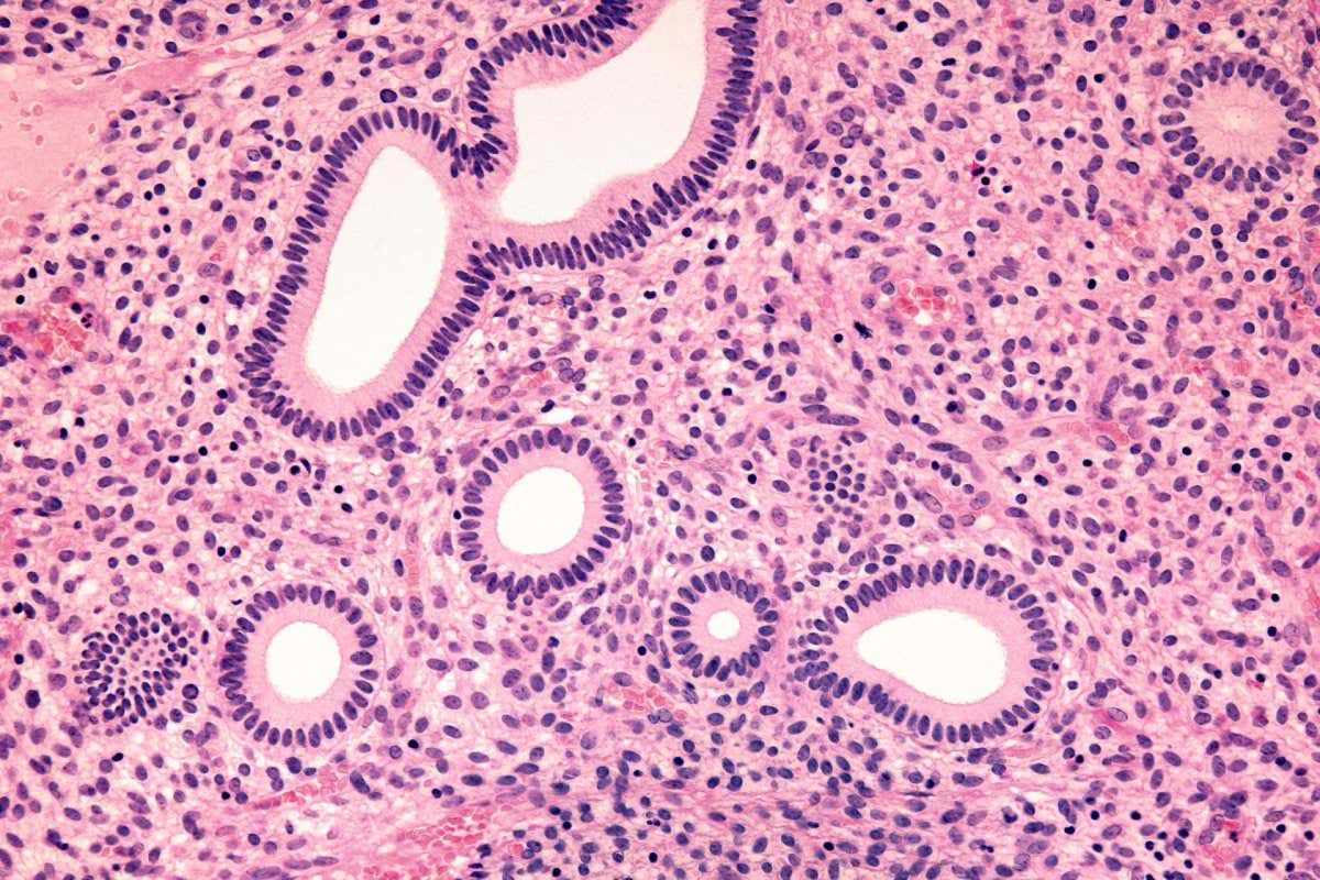 Endometriosis Study Identifies 300 Genes for New Treatments - Image 3