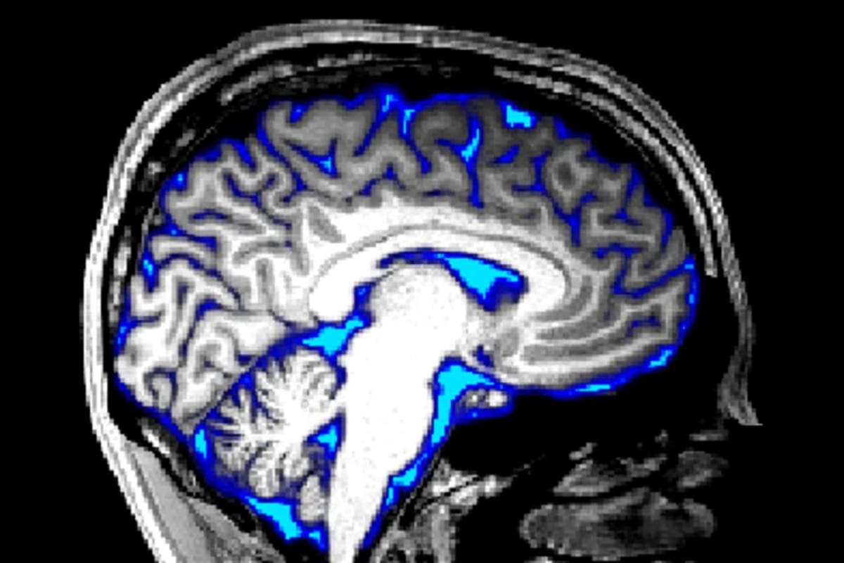 New Brain Treatment Boosts Memory in Alzheimer's Mice - Image 3