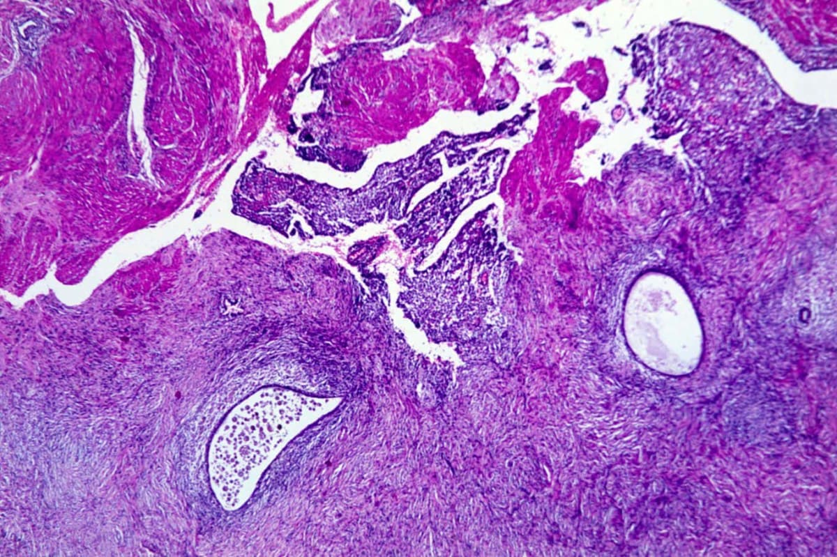 Endometriosis Study Identifies 300 Genes for New Treatments - Image 2