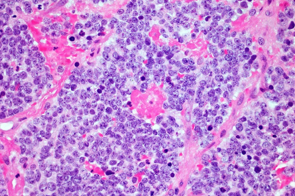 Making Cancer Cells Stiffer Boosts Immunotherapy Success - Image 5