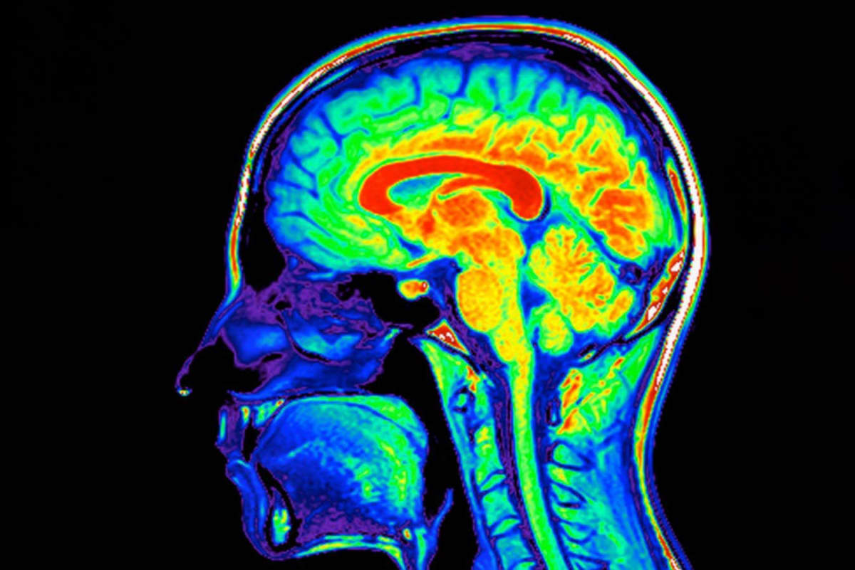 New Drug Combo May Delay Alzheimer's by 7 Years - Image 2