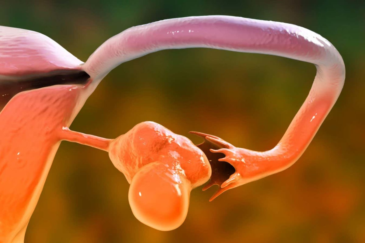 PCOS Gets New Name That Finally Explains the Condition - Image 5