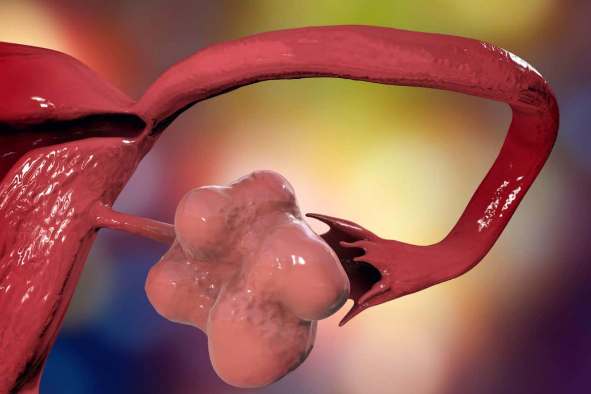 PCOS Gets New Name That Finally Explains the Condition - Image 2