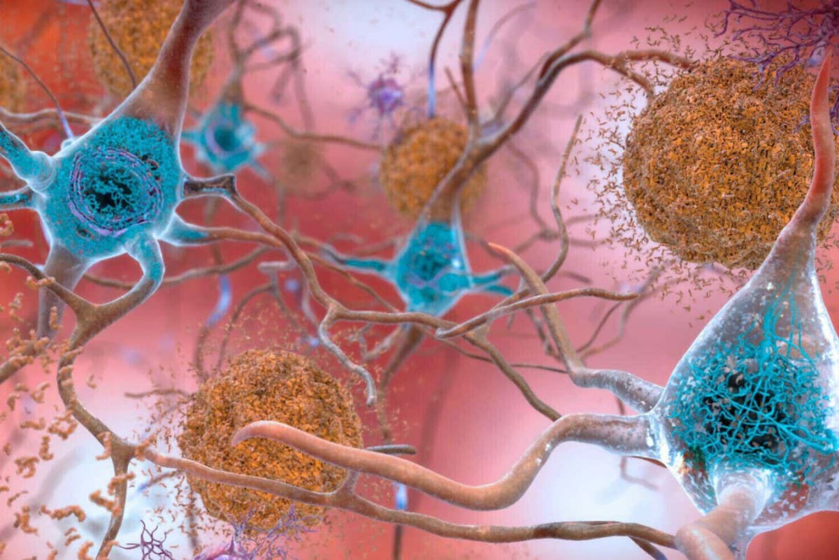 6 Simple Steps Cut Alzheimer's Risk While Boosting Health - Image 5