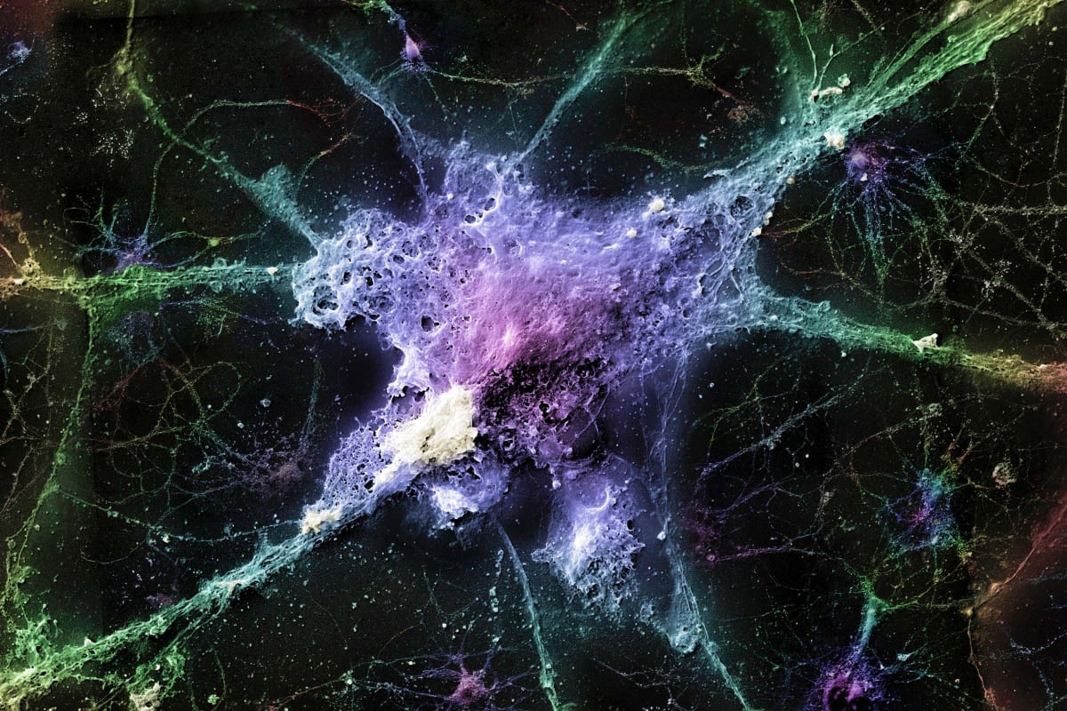 Microscope image of mouse nerve cell affected by misfolded proteins in Alzheimer's disease
