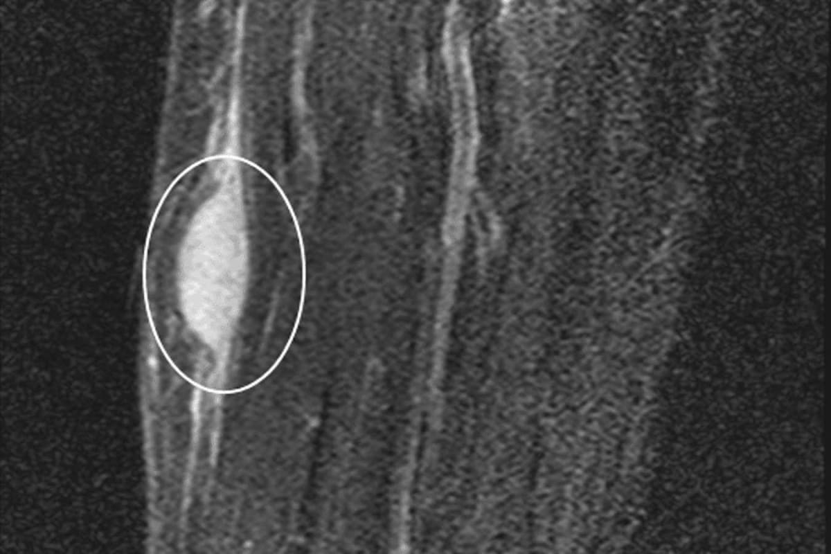 Woman's Cancer Vanishes After Simple Biopsy in Wisconsin - Image 3